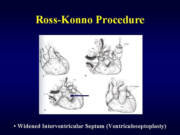 Ross-Konno Procedure • Widened Interventricular Septum (Ventriculoseptoplasty) 