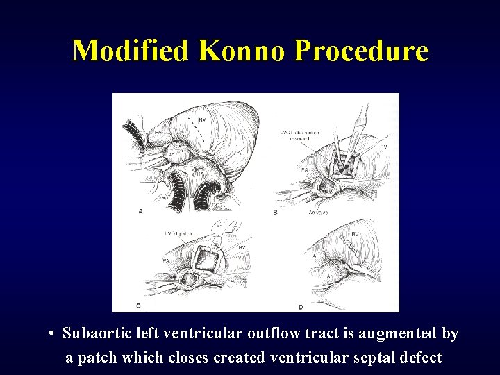 Modified Konno Procedure • Subaortic left ventricular outflow tract is augmented by a patch