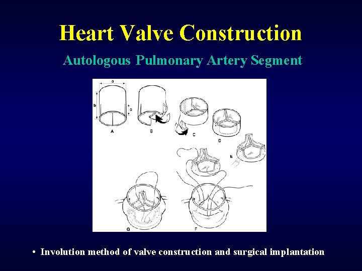 Heart Valve Construction Autologous Pulmonary Artery Segment • Involution method of valve construction and