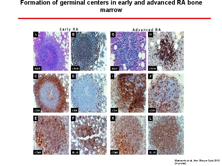 Formation of germinal centers in early and advanced RA bone marrow Warnawin et al.