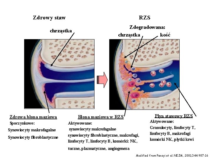 Zdrowy staw RZS chrząstka Zdrowa błona maziowa Spoczynkowe: Synowiocyty makrofagalne Synowiocyty fibroblastyczne Zdegradowana: chrząstka Zdrowy staw RZS chrząstka Zdrowa błona maziowa Spoczynkowe: Synowiocyty makrofagalne Synowiocyty fibroblastyczne Zdegradowana: chrząstka