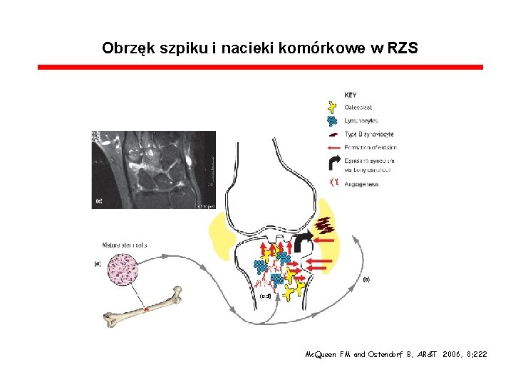 Obrzęk szpiku i nacieki komórkowe w RZS Mc. Queen FM and Ostendorf B, AR&T