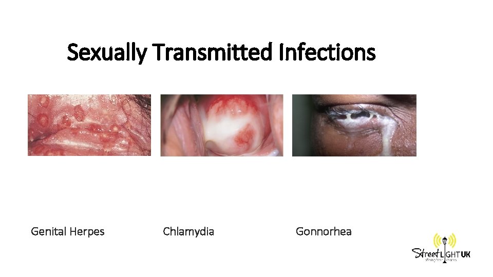 Sexually Transmitted Infections Genital Herpes Chlamydia Gonnorhea 