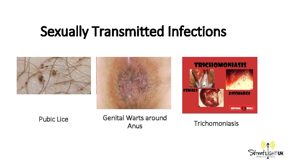 Sexually Transmitted Infections Pubic Lice Genital Warts around Anus Trichomoniasis 