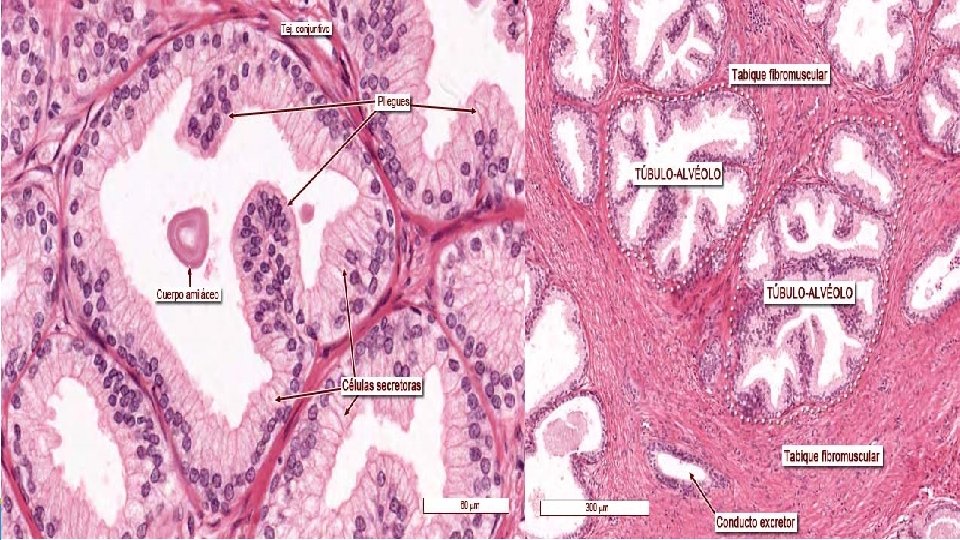 Próstata Glándula con forma de una nuez, se encuentra rodeando a la uretra masculina