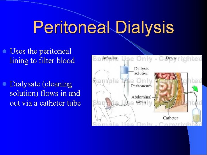 Peritoneal Dialysis l Uses the peritoneal lining to filter blood l Dialysate (cleaning solution)