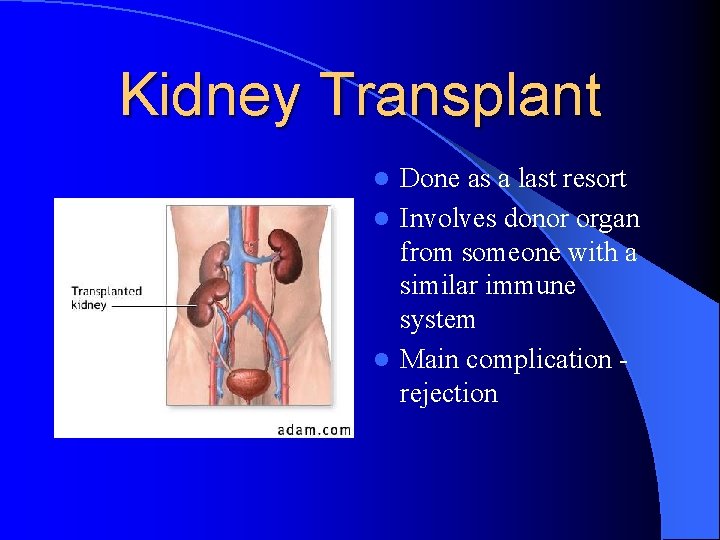 Kidney Transplant Done as a last resort l Involves donor organ from someone with Kidney Transplant Done as a last resort l Involves donor organ from someone with