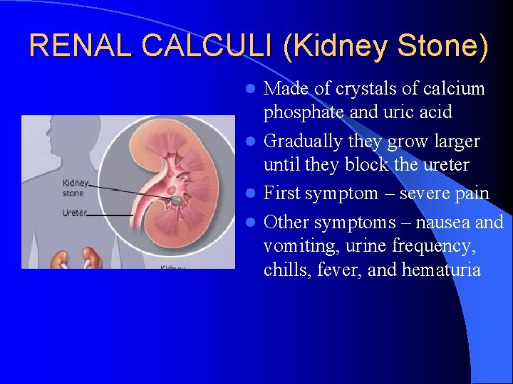 RENAL CALCULI (Kidney Stone) Made of crystals of calcium phosphate and uric acid l RENAL CALCULI (Kidney Stone) Made of crystals of calcium phosphate and uric acid l