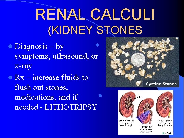 RENAL CALCULI (KIDNEY STONES l Diagnosis l – by symptoms, utlrasound, or x-ray l