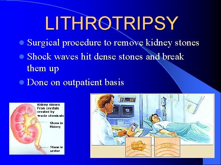 LITHROTRIPSY l Surgical procedure to remove kidney stones l Shock waves hit dense stones