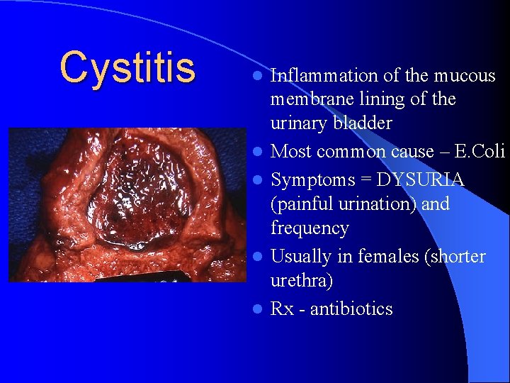 Cystitis l l l Inflammation of the mucous membrane lining of the urinary bladder Cystitis l l l Inflammation of the mucous membrane lining of the urinary bladder