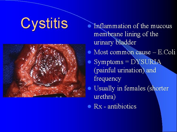 Cystitis l l l Inflammation of the mucous membrane lining of the urinary bladder