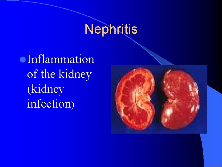 Nephritis l Inflammation of the kidney (kidney infection) Nephritis l Inflammation of the kidney (kidney infection)