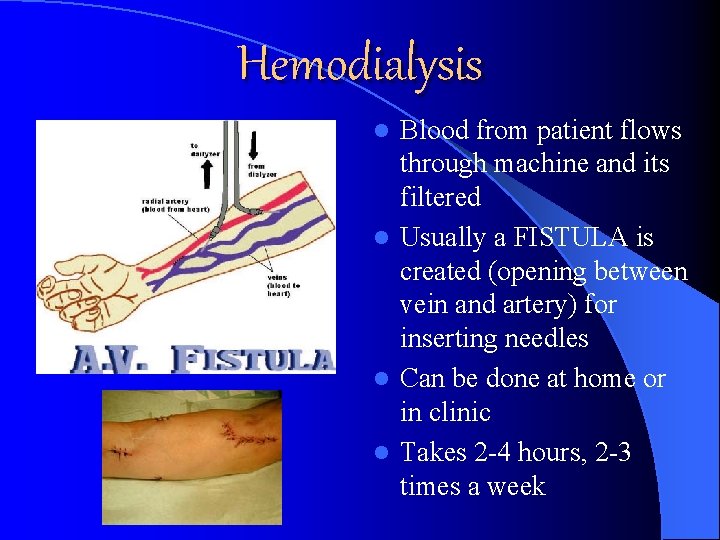 Hemodialysis Blood from patient flows through machine and its filtered l Usually a FISTULA