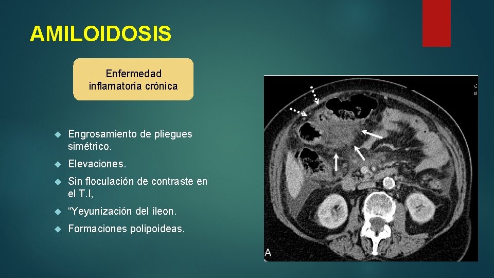 AMILOIDOSIS Enfermedad inflamatoria crónica Engrosamiento de pliegues simétrico. Elevaciones. Sin floculación de contraste en