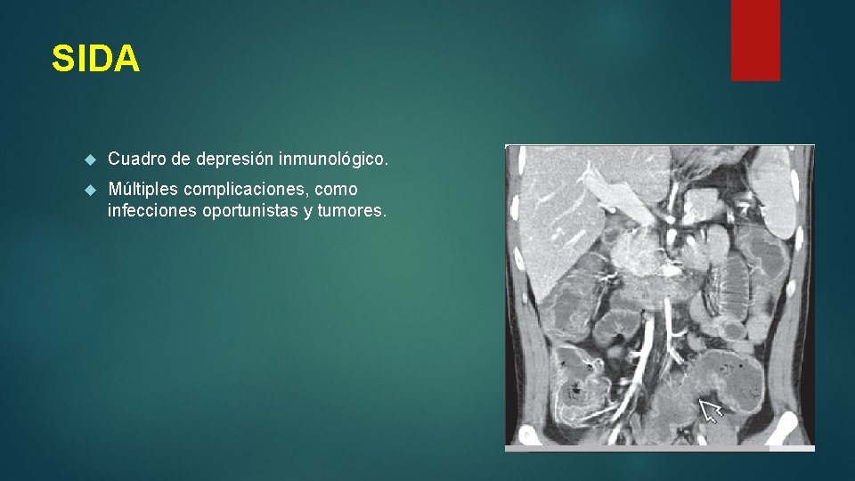 SIDA Cuadro de depresión inmunológico. Múltiples complicaciones, como infecciones oportunistas y tumores. 