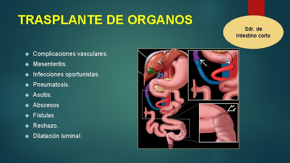 TRASPLANTE DE ORGANOS Complicaciones vasculares. Mesenteritis. Infecciones oportunistas. Pneumatosis. Ascitis. Abscesos Fístulas Rechazo. Dilatación