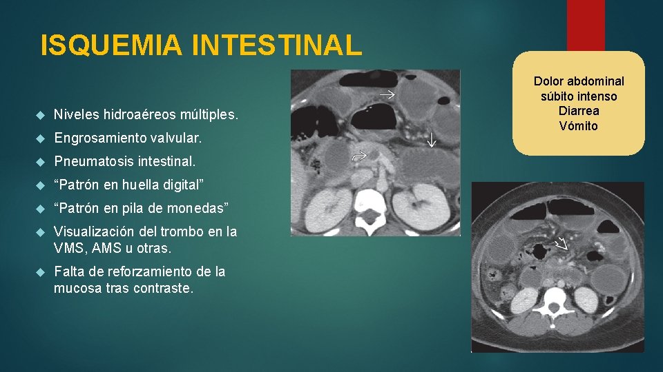 ISQUEMIA INTESTINAL Niveles hidroaéreos múltiples. Engrosamiento valvular. Pneumatosis intestinal. “Patrón en huella digital” “Patrón
