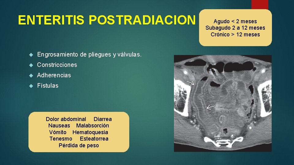 ENTERITIS POSTRADIACION Engrosamiento de pliegues y válvulas. Constricciones Adherencias Fístulas Dolor abdominal Diarrea Nauseas