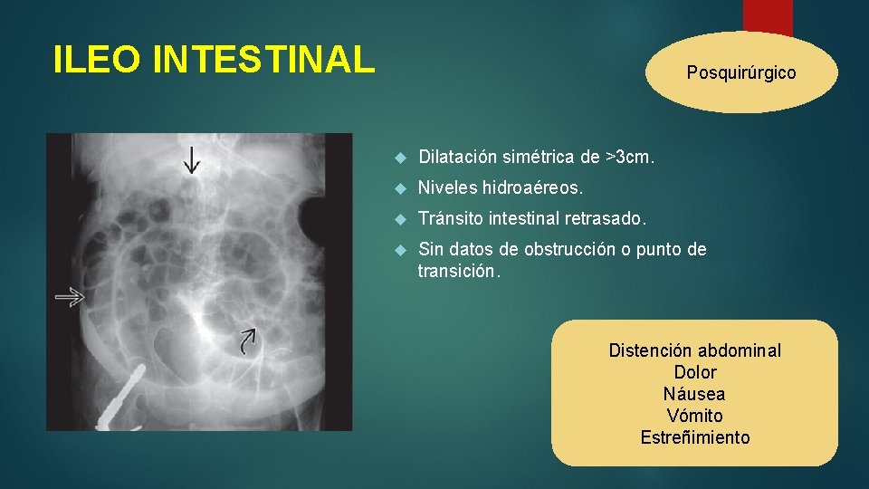 ILEO INTESTINAL Posquirúrgico Dilatación simétrica de >3 cm. Niveles hidroaéreos. Tránsito intestinal retrasado. Sin