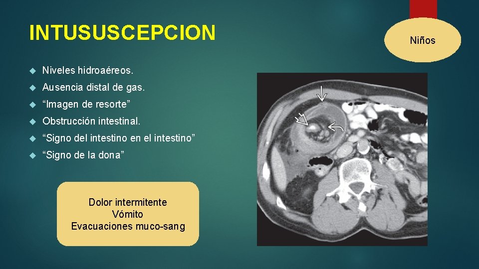 INTUSUSCEPCION Niveles hidroaéreos. Ausencia distal de gas. “Imagen de resorte” Obstrucción intestinal. “Signo del