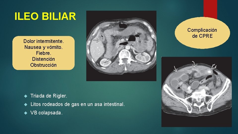 ILEO BILIAR Dolor intermitente. Nausea y vómito. Fiebre. Distención Obstrucción Triada de Rigler. Litos