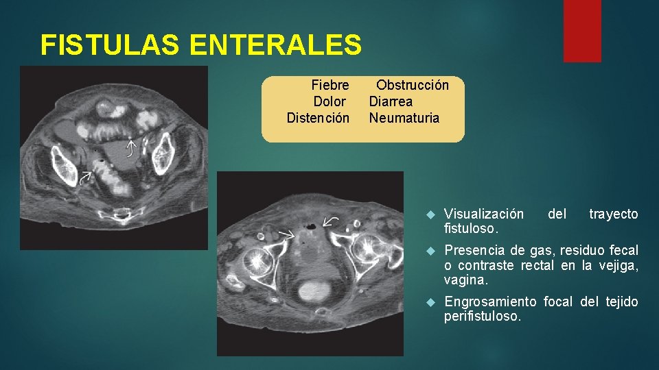 FISTULAS ENTERALES Fiebre Dolor Distención Obstrucción Diarrea Neumaturia Visualización fistuloso. del trayecto Presencia de