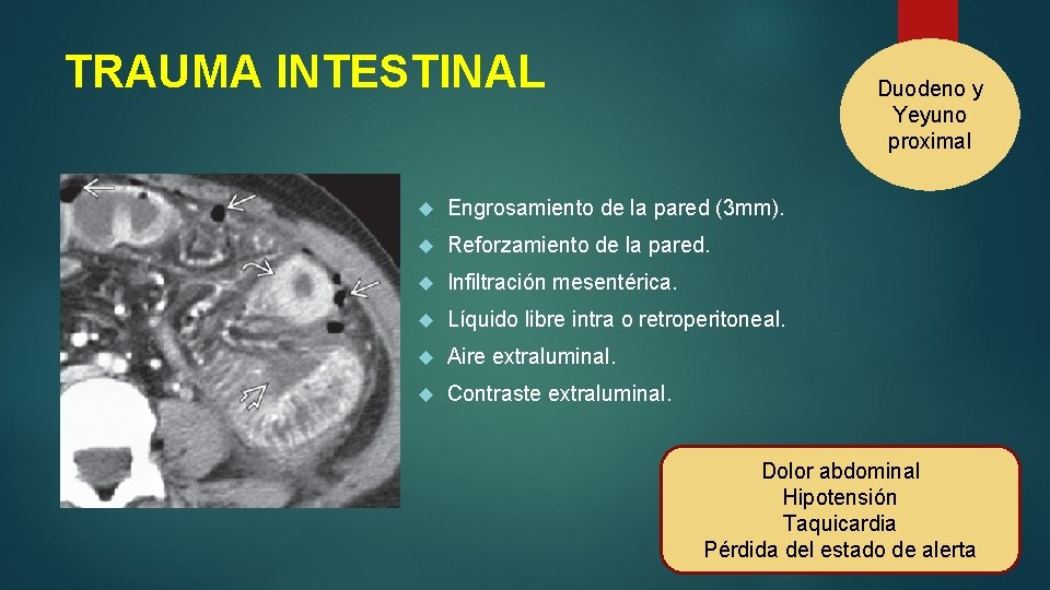 TRAUMA INTESTINAL Duodeno y Yeyuno proximal Engrosamiento de la pared (3 mm). Reforzamiento de