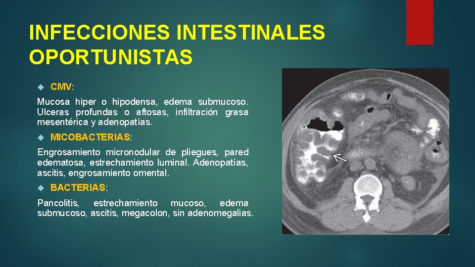 INFECCIONES INTESTINALES OPORTUNISTAS CMV: Mucosa hiper o hipodensa, edema submucoso. Ulceras profundas o aftosas,