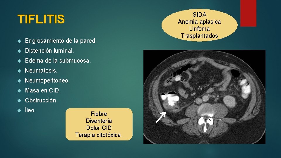 TIFLITIS Engrosamiento de la pared. Distención luminal. Edema de la submucosa. Neumatosis. Neumoperitoneo. Masa