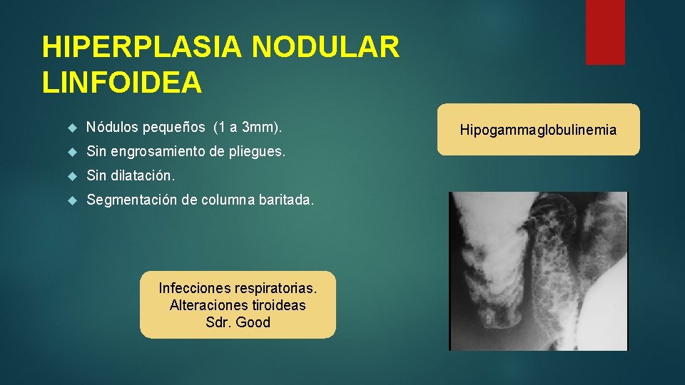 HIPERPLASIA NODULAR LINFOIDEA Nódulos pequeños (1 a 3 mm). Sin engrosamiento de pliegues. Sin