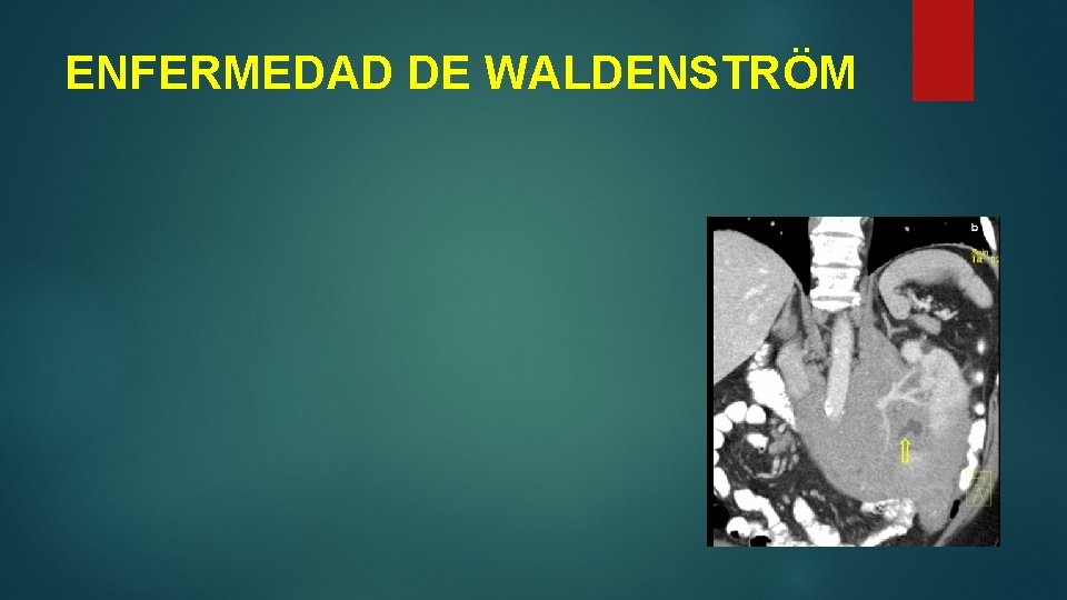 ENFERMEDAD DE WALDENSTRÖM 