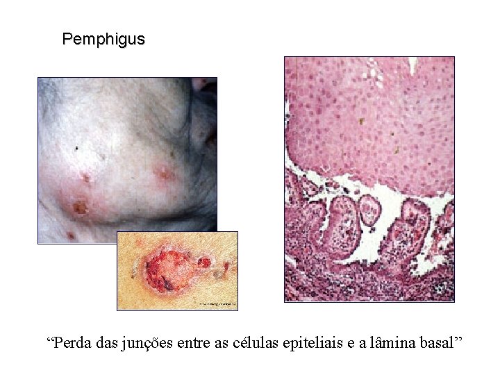 Pemphigus “Perda das junções entre as células epiteliais e a lâmina basal” 