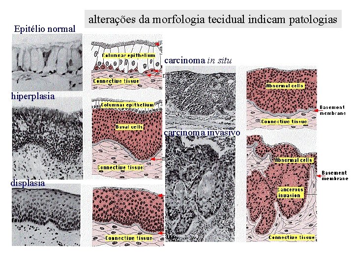 Epitélio normal alterações da morfologia tecidual indicam patologias carcinoma in situ membrana basal hiperplasia