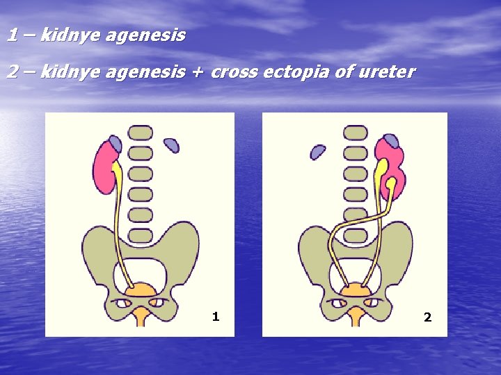 1 – kidnye agenesis 2 – kidnye agenesis + cross ectopia of ureter 1