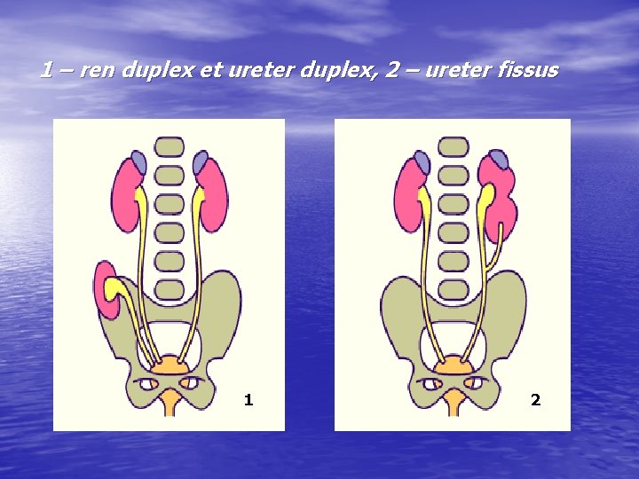 1 – ren duplex et ureter duplex, 2 – ureter fissus 1 2 