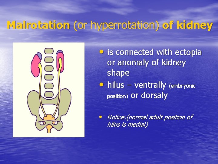 Malrotation (or hyperrotation) of kidney • is connected with ectopia • or anomaly of