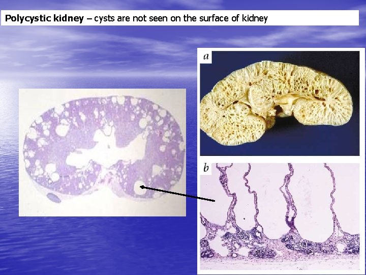 Polycystic kidney – cysts are not seen on the surface of kidney 