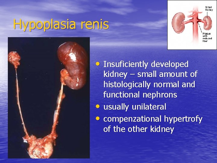 Hypoplasia renis • Insuficiently developed • • kidney – small amount of histologically normal