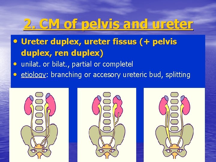 2. CM of pelvis and ureter • Ureter duplex, ureter fissus (+ pelvis duplex,