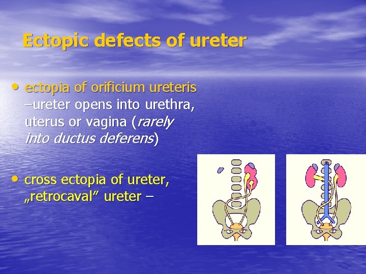 Ectopic defects of ureter • ectopia of orificium ureteris –ureter opens into urethra, uterus