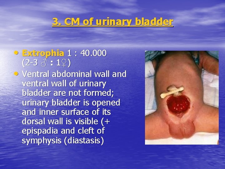 3. CM of urinary bladder • Extrophia 1 : 40. 000 • (2 -3