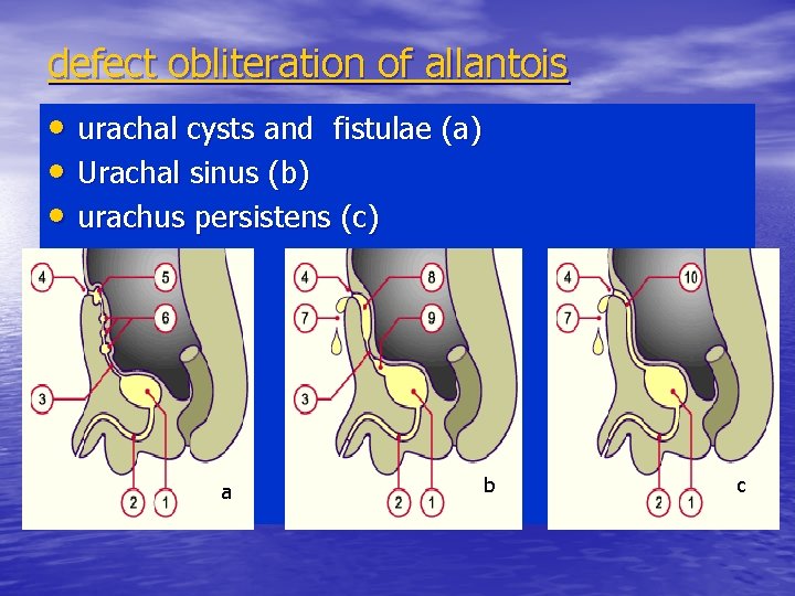 defect obliteration of allantois • urachal cysts and fistulae (a) • Urachal sinus (b)