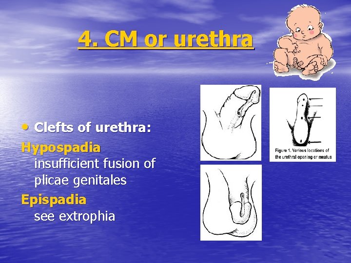 4. CM or urethra • Clefts of urethra: Hypospadia insufficient fusion of plicae genitales