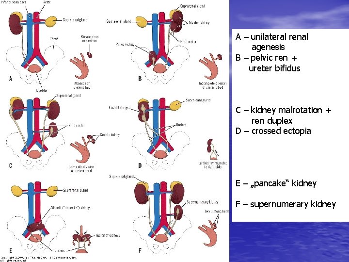 A – unilateral renal agenesis B – pelvic ren + ureter bifidus C –