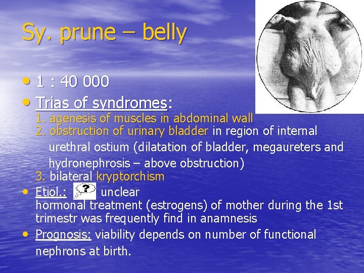 Sy. prune – belly • 1 : 40 000 • Trias of syndromes: •