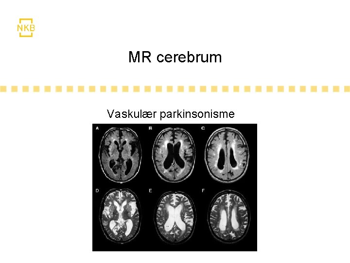 MR cerebrum Vaskulær parkinsonisme 