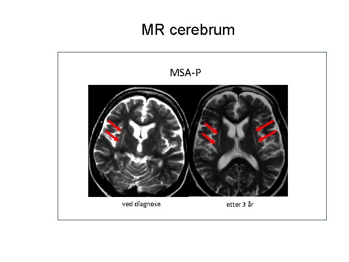MR cerebrum MSA-P ved diagnose etter 3 år MR cerebrum MSA-P ved diagnose etter 3 år