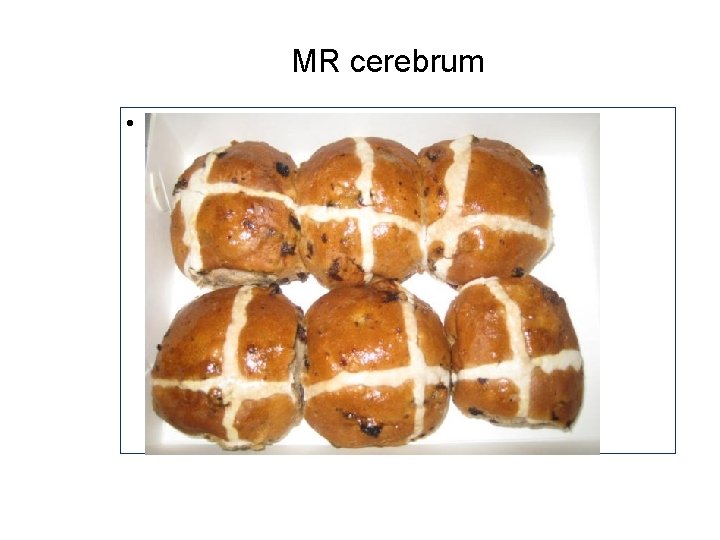 MR cerebrum • MSA-C MR cerebrum • MSA-C