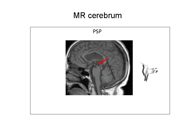 MR cerebrum PSP MR cerebrum PSP